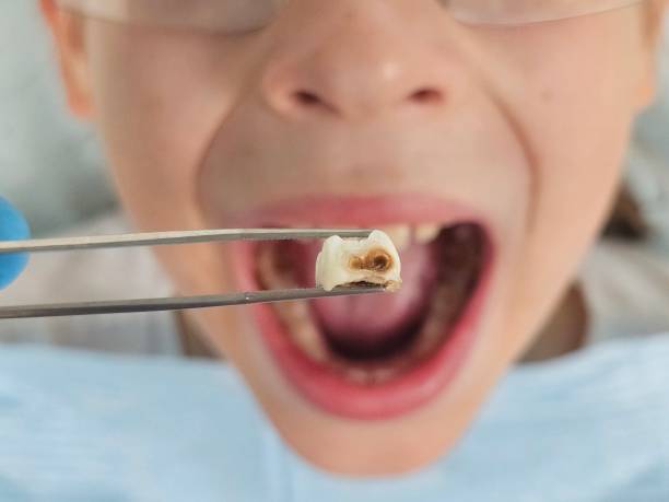Best Emergency Root Canal Treatment in Westphalia, MD